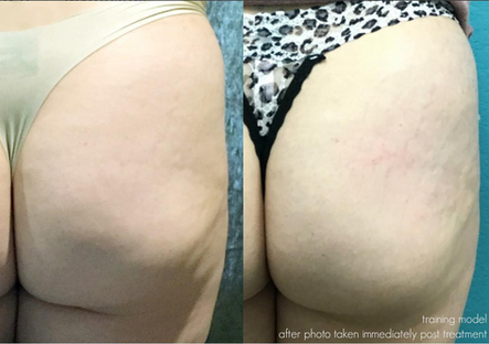 All the Right Moves: Sculptra and Kybella Treatments for Shaping and Augmenting in All the Right Pla: Body Tonic RX journal article, Austin, TX