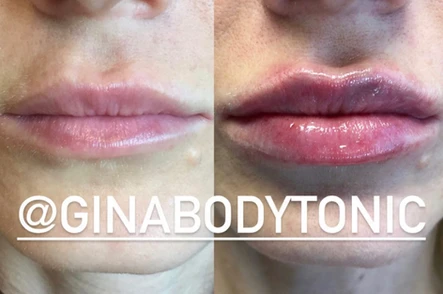 Appendectomy, Dreams and Lip Injections: Body Tonic RX journal article, Austin, TX