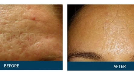 Best Treatments for Acne Scarring: Body Tonic RX journal article, Austin, TX