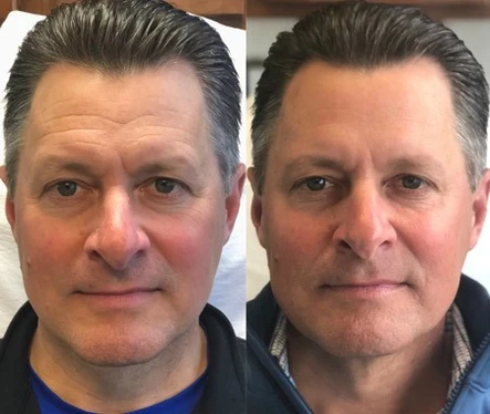 Botox Cosmetic: Focus on Injections for Men: Body Tonic RX journal article, Austin, TX