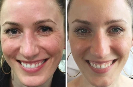 Botox for Better Skin Quality: Body Tonic RX journal article, Austin, TX