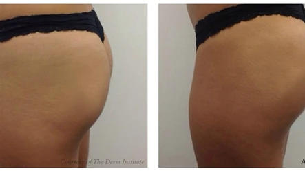 Bottoms Up: Sculptra, Vanquish and Kybella are the New Cocktail for Your Backside: Body Tonic RX journal article, Austin, TX