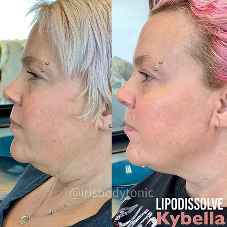 Chin Up! Kybella for Dissolving “Double Chin”: Body Tonic RX journal article, Austin, TX