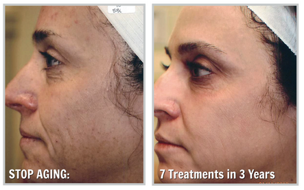 Forever Young BBL: Proven to Reverse the Signs of Aging: Body Tonic RX journal article, Austin, TX