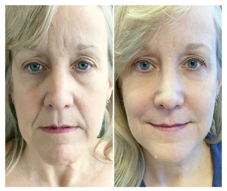 How to NOT Buy Disappointment: A Guide to How Much Filler You’ll Need: Body Tonic RX journal article, Austin, TX
