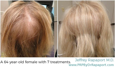 How to Not Be Bald: PRP for Hair Restoration: Body Tonic RX journal article, Austin, TX