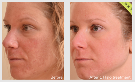 I Had the Halo Laser Treatment, Here’s What Happened: Body Tonic RX journal article, Austin, TX