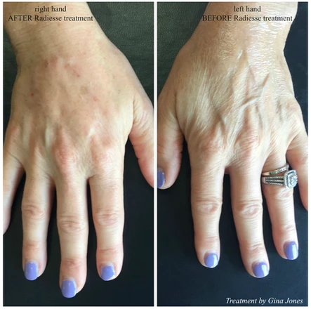 It’s Handled! Treatment Options for Hand Beautification: Body Tonic RX journal article, Austin, TX