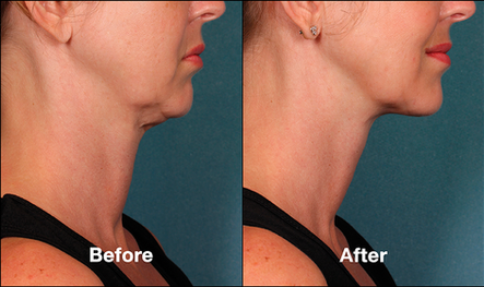 Just in Time for Thanksgiving…No More Turkey Waddle with Kybella (and some free Voluma!): Body Tonic RX journal article, Austin, TX