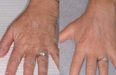 Micro Laser Peel Treatment: Get Your Hands Looking Like You’re in College Again: Body Tonic RX journal article, Austin, TX