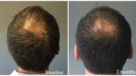 PRP: A Real Hair Miracle: Body Tonic RX journal article, Austin, TX