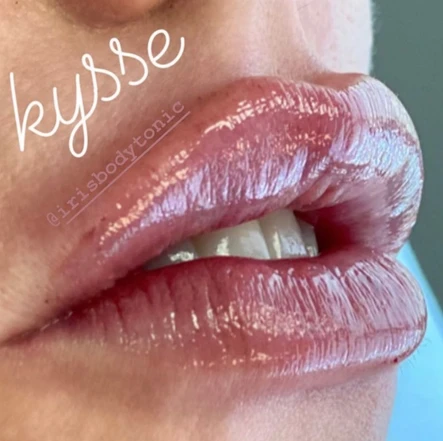 Post-Quarantine Goodies: A New Lip Filler and a Deep Chemical Peel: Body Tonic RX journal article, Austin, TX