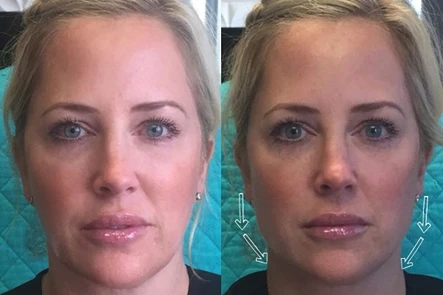 Radiesse for Redefining the Jawline: Body Tonic RX journal article, Austin, TX