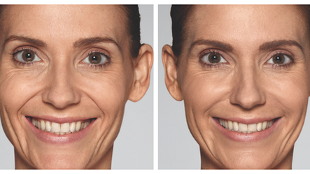 Redefyning Beauty? Welcome the Newest Fillers: Restylane Refyne and Defyne: Body Tonic RX journal article, Austin, TX