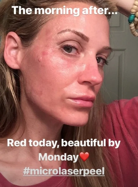 Shedding Skin: The Micro Laser Peel: Body Tonic RX journal article, Austin, TX