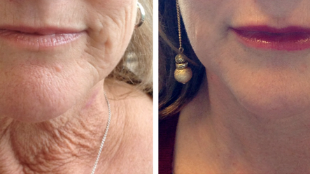 Subtlety in Beauty: Yes, We All Have Filler: Body Tonic RX journal article, Austin, TX