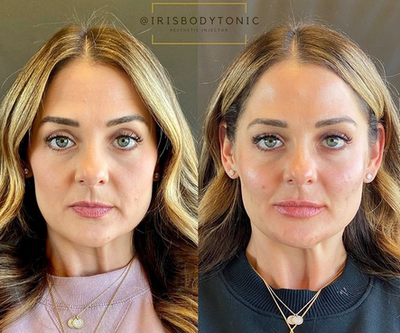 The Most Frequently Asked Questions About Fillers + Botox: Body Tonic RX journal article, Austin, TX