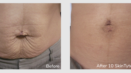 SkinTyte is Coming This Month! Tighten Everything From Your Eyes to Your Knees!: Body Tonic RX journal article, Austin, TX