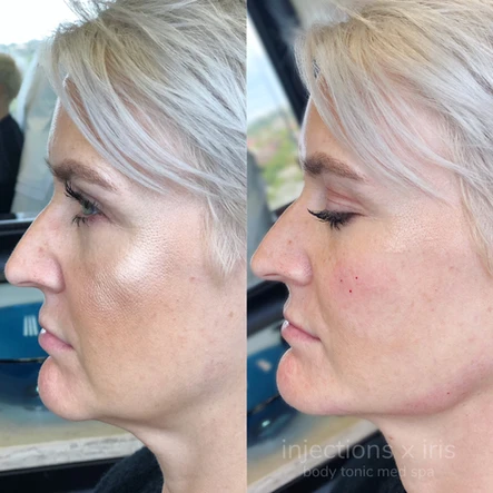 Trending Treatment: Radiesse for Jawline Definition: Body Tonic RX journal article, Austin, TX