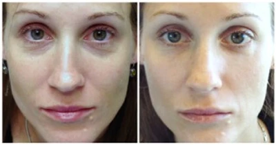 Restylane for Rested Eyes: tear trough injections for improving dark circles and under-eye puffiness: Body Tonic RX journal article, Austin, TX