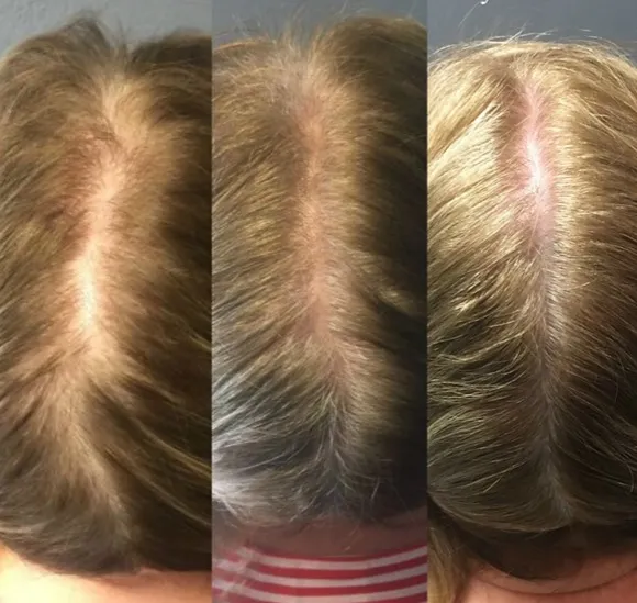Get Growing: PRP for Hair Restoration: Body Tonic RX journal article, Austin, TX