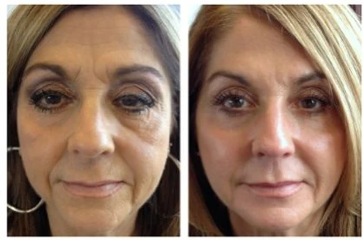 Liquid Facelift: the amazing results and instant gratification of a non-surgical facelift: Body Tonic RX journal article, Austin, TX