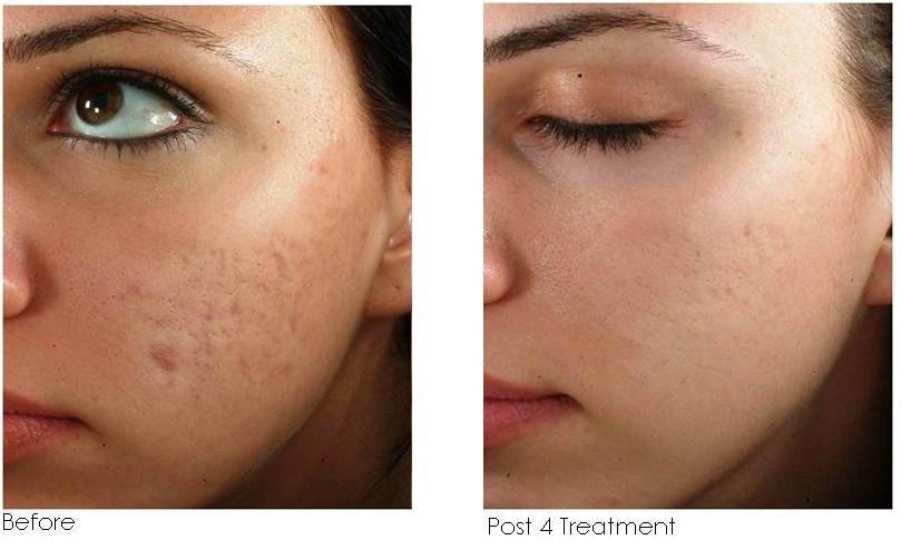 Microneedling: A Staff Fave: Body Tonic RX journal article, Austin, TX