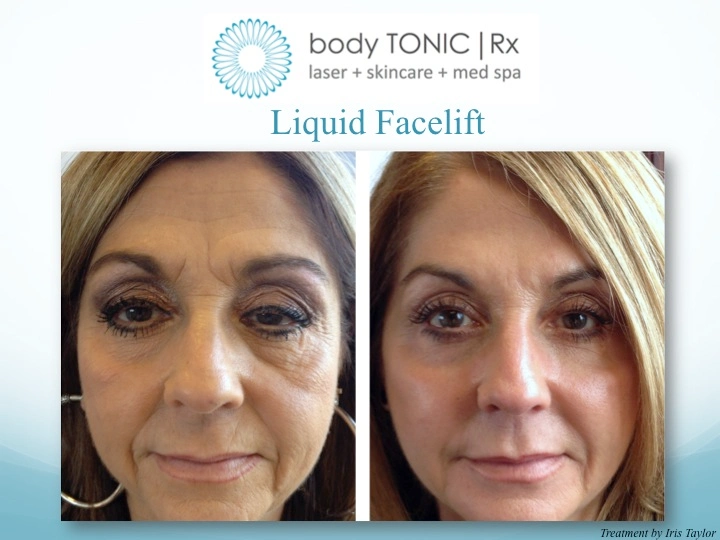 This is What a Liquid Facelift Looks Like: Body Tonic RX journal article, Austin, TX