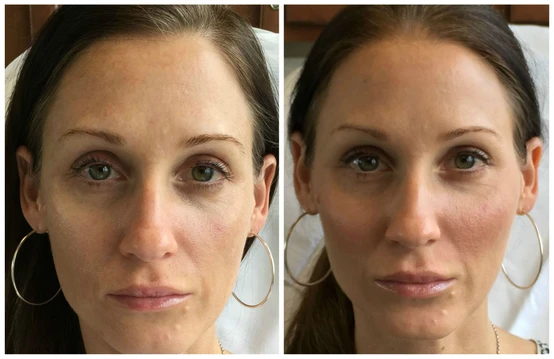 Sweet Cheeks! It Started as Marketing But Ended As Love: Restylane Lyft for Cheek Enhancement: Body Tonic RX journal article, Austin, TX
