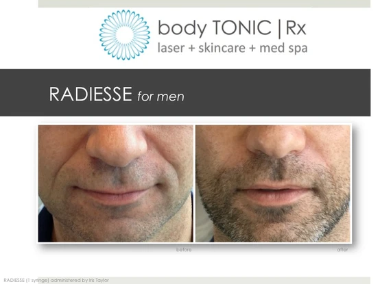 The Full Treatment: Radiesse for Hands, Cellulite, Earlobes and Face: Body Tonic RX journal article, Austin, TX