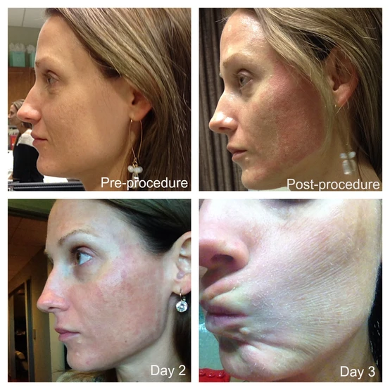 Whisper Chatter: A Diary of the Most Popular Laser Skin Treatment: Body Tonic RX journal article, Austin, TX