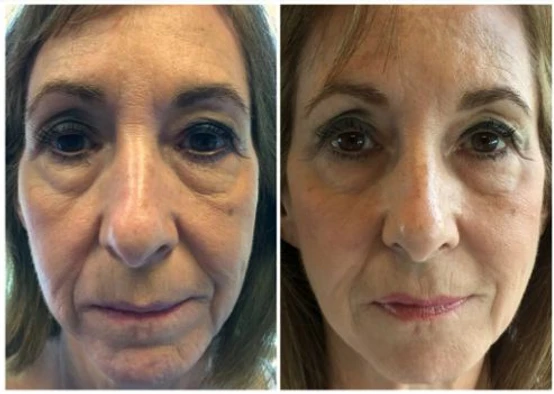 Looking “Betta”: Loving on Our Before and Afters of Juvederm, Voluma and Belotero: Body Tonic RX journal article, Austin, TX