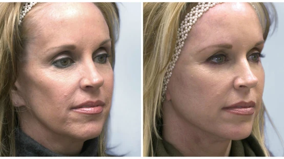Spectacular Sculptra: Re-Grow Your Own Collagen with This Amazing Facial Volumizer: Body Tonic RX journal article, Austin, TX