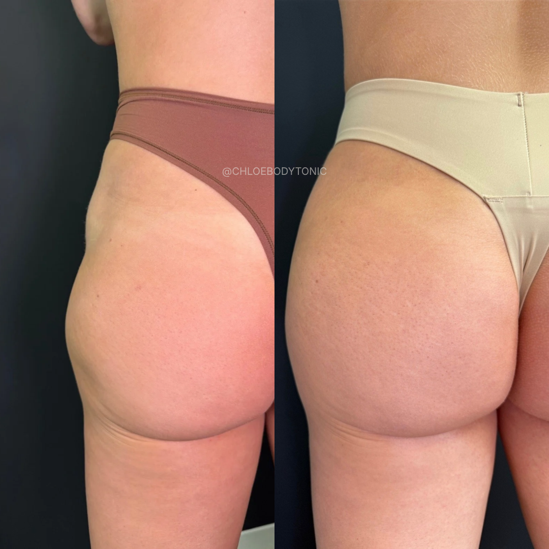 BBL Filler in Austin: Radiesse vs. Sculptra for a Non-Surgical Butt Lift: Body Tonic RX journal article, Austin, TX